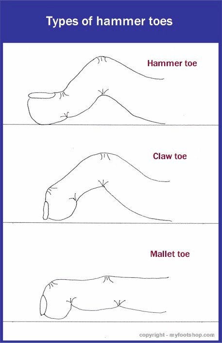 Three types of hammer toes